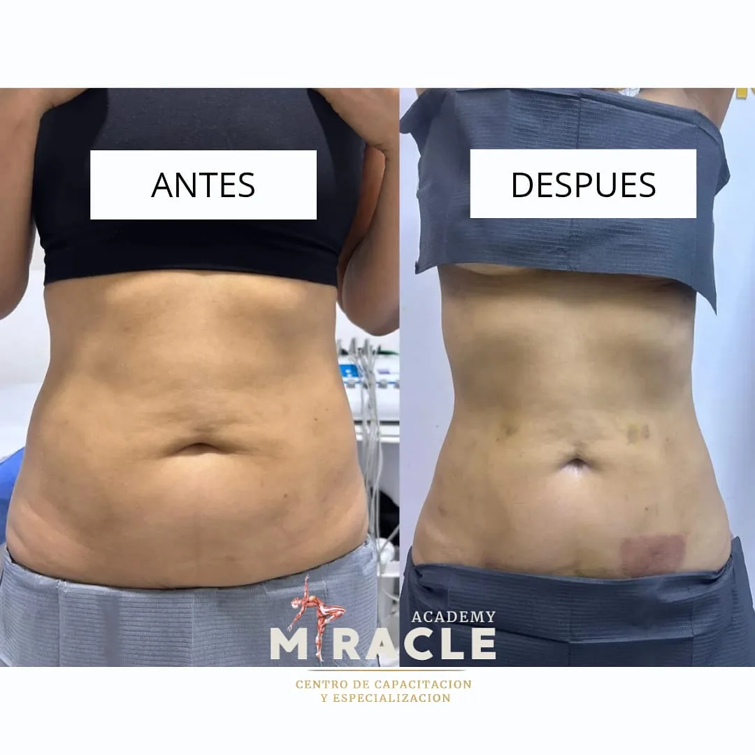 Resultado corporal de Myracle Latam