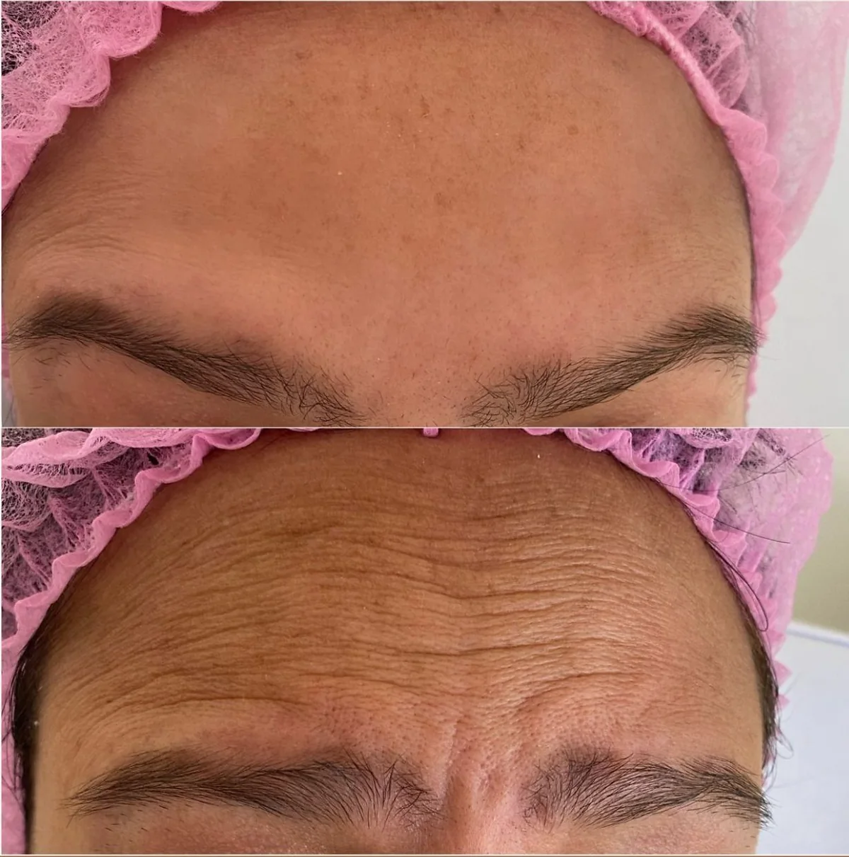 B&oacute;tox facial y bienestar