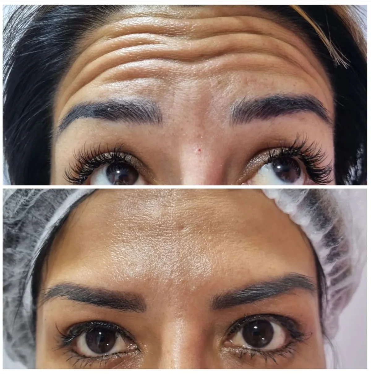 Resultado de b&oacute;tox facial
