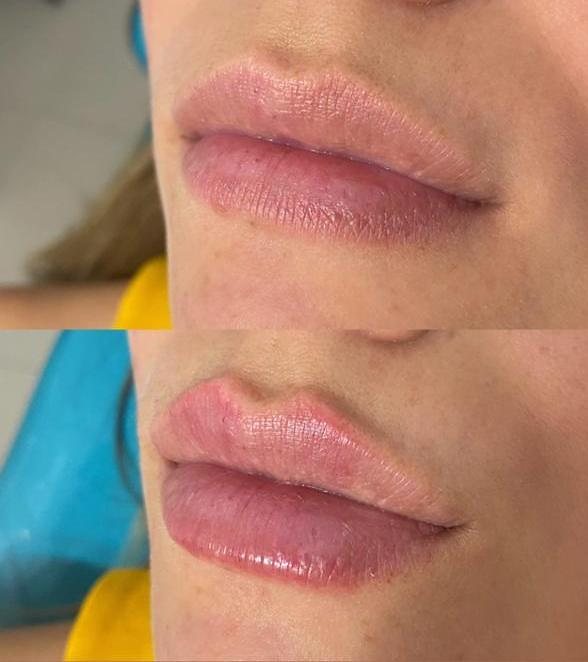 Resultado de labios en Myracle Latam