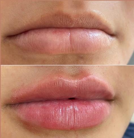 Resultado labios